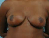 Patient # 45060 After Photo # 2
